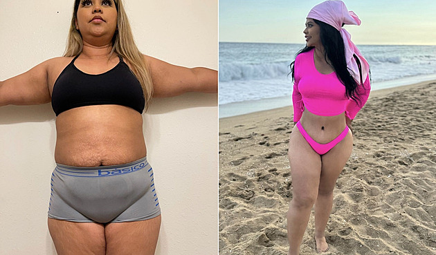 Nemohla se zbavit vytahaného bříška, tak si žena zaletěla pro plastiku