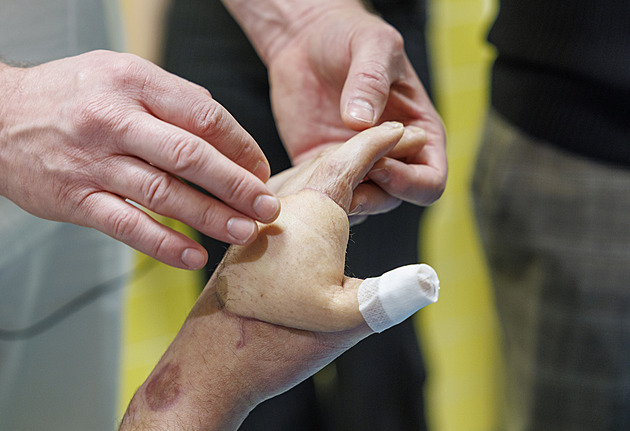 Elektrický proud znetvořil muži ruku, unikátní zákrok lékařů odvrátil amputaci