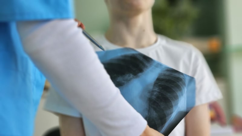 Tuberkulóza znovu straší Česko. Počet nemocných roste, lékaři volají po přísných kontrolách